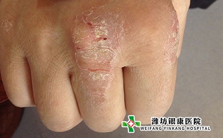 潍坊市银康皮肤病医院：我们怎样区分手癣或者手部的湿疹