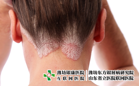 摄图网_327927894_毛发和头皮上的psorpalpic（企业商用）