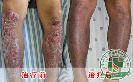随着时间的洗礼你的银屑病治可以了吗？