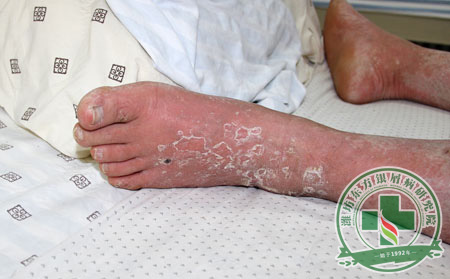 银屑病食疗3类瓜果保健康!