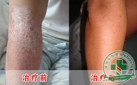 儿童得了银屑病要怎么治疗可以?