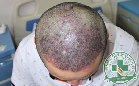 头部牛皮癣病人在夏季如何做可以护理?