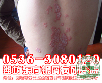 牛皮癣患者尽量不要食用胭脂咸菜