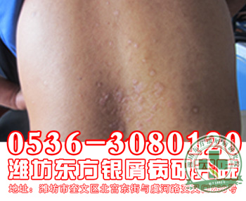 食疗解牛皮癣患者“便秘”