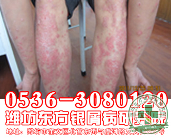 医院献血会传染牛皮癣吗?