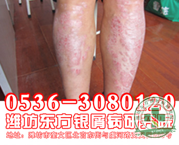 红版型牛皮癣和血液什么关系