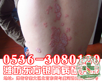银屑病饮食需注意哪些问题