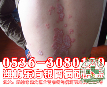 银屑病患者四季沐浴的自身调理有哪些