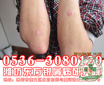 炎热的夏季牛皮癣患者改如何对生命之水保持可以关系