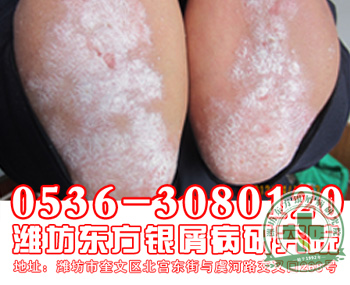 诱发点滴型牛皮癣的重要因素有哪些