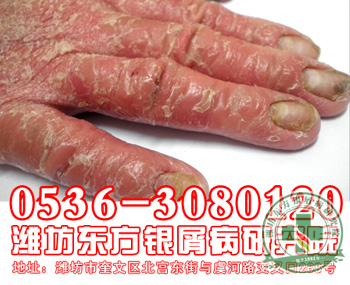 女性牛皮癣患者经期禁忌喝酒