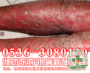 红皮型银屑病症状什么样?