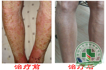 男性,银屑,病患者,早期,应注意,什么,银屑,病患者,大多数