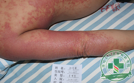 关注所有银屑病患者都该了解的护理问题