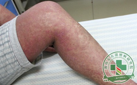潍坊银屑病患者如何护理预防感染?