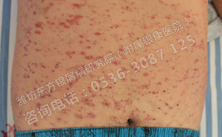 潍坊银屑病怎么治疗可以呢