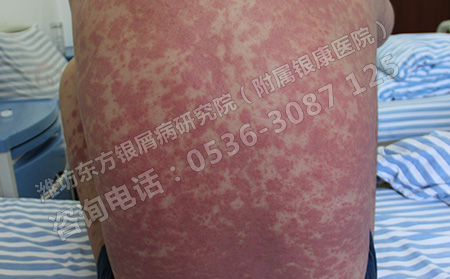 银屑病患者怎样远离心理危害
