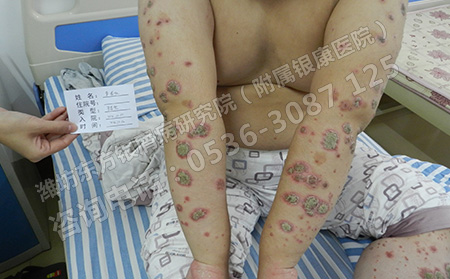 潍坊治疗银屑病哪家医院可以
