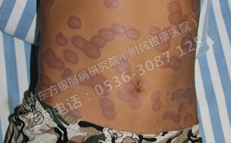 潍坊医生指导，什么样的医院可以治可以银屑病