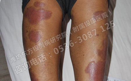 老年银屑病患者怎样治治疗效果果可以