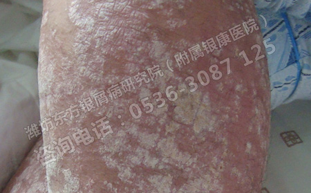 潍坊哪个医院治牛皮癣可以