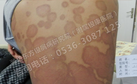 为什么银屑病越治越重治不可以