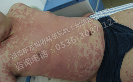 潍坊银屑病医院春季护理公告