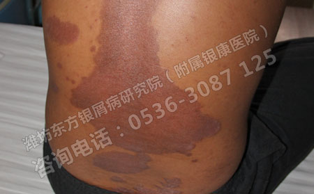 潍坊寻常型银屑病该怎么预防