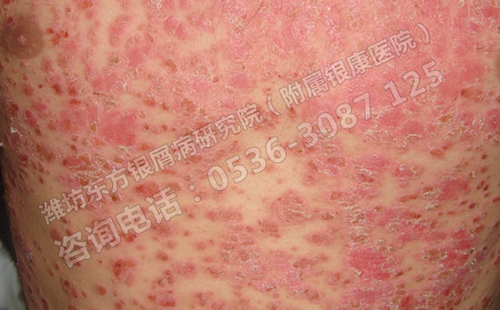 潍坊银屑病怎么治疗可以