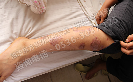 红斑症状是否就能确定是牛皮癣呢