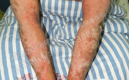 治疗银屑病选择什么方法可以呢