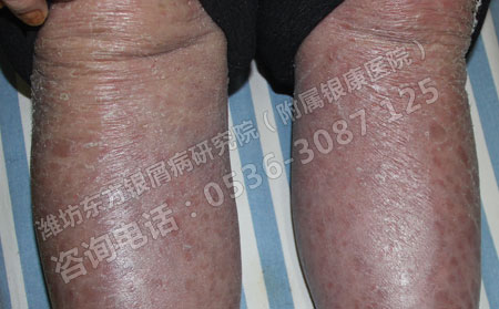 怎么治疗久治不愈的牛皮癣呢