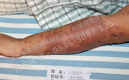 潍坊治疗银屑病的医院哪家可以