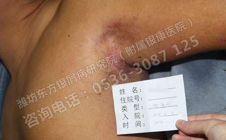 多年顽固性银屑病治疗多点耐心和信心