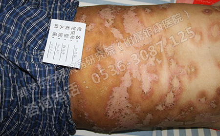 牛皮癣饮食需要忌口吗
