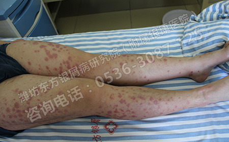 银屑病治可以期要怎么护理呢