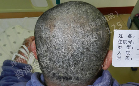 何来,诊断,头部,银屑病,头部,银屑病,怎么,诊断,一种,顽