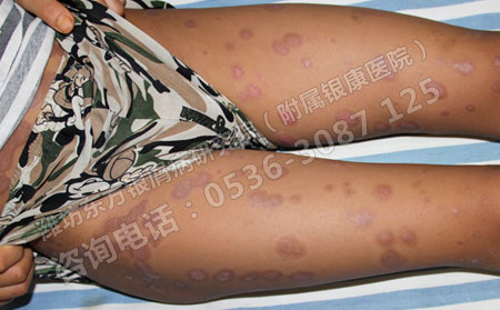 银屑病患者夏季饮食需要注意哪些