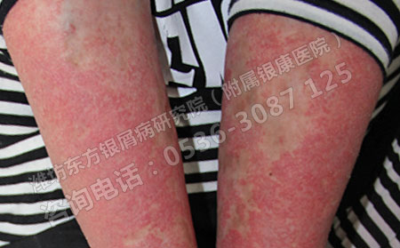 红皮型银屑病患者怎样做有利于病情的恢复？