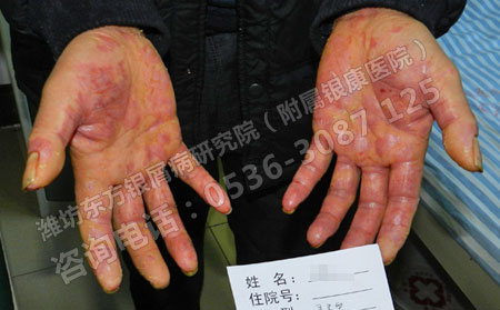 银屑病患者们银屑病的危害你们知道吗？