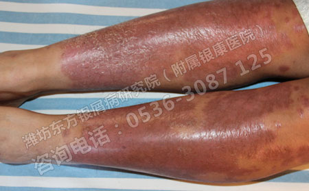 银屑病对男性患者的日常生活带来什么影响？