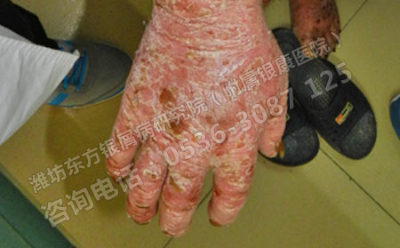 关节型银屑病会对患者的身体造成哪些影响？