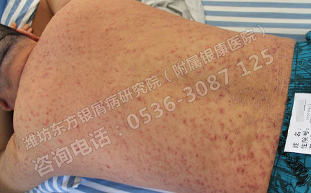 牛皮癣针对不同人群的危害你知道吗?