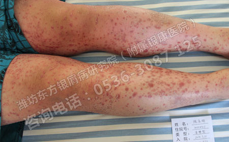 牛皮癣不同阶段的治疗方法不同