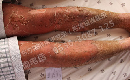 能够确保儿童银屑病治疗有效的方法是什么？