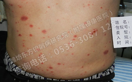 这些做法可以减少牛皮癣的治疗时间