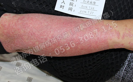 孕妇患有牛皮癣应该怎样处理?