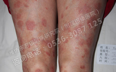 排汗对牛皮癣患者来说有哪些可以处？