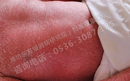 潍坊银屑病医院提醒：用激素治疗牛皮癣危险重重