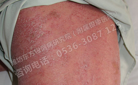 潍坊东方银屑病研究院分析牛皮癣的治疗不忘“治心”